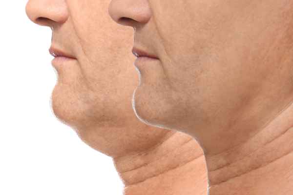 HIFU - Breakthrough in Anti - ageing 2 hifu results Hatfield
