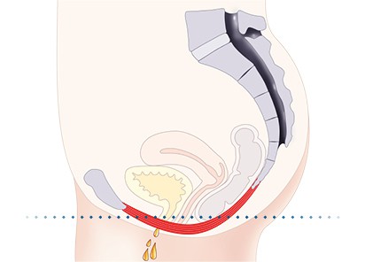 Pelvic-Floor Muscle Repair 5 Pelvic floor muscles Hatfield