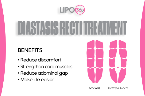Revolutionising Muscle Repair: The Power of LIPO360 Body Sculpt Post-Injury 5 diastasis recti treatment Hatfield