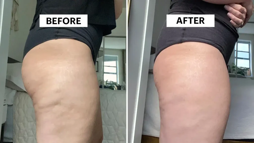Do Toning Exercise Hatfield Really Tackle Cellulite?