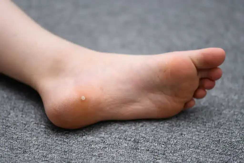 Cryotherapy For Warts And Also Verrucas 2 Image of verruca on the bottom of the foot that able to be treated with Cryotherapy Hatfield