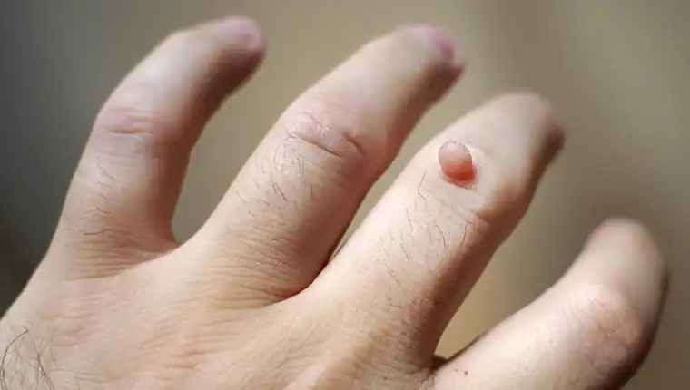 Image of blemish that Cryotherapy Hatfield can remove with Lipo 360.