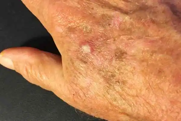Image of Actinic keratoses Hatfield on a person hand