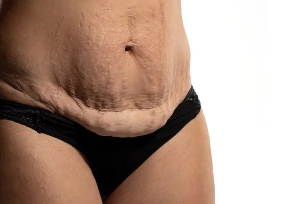 The Science of Skin Tightening 1 The science behind skin tightening Hatfield picture of a woman's sagging skin on the stomach